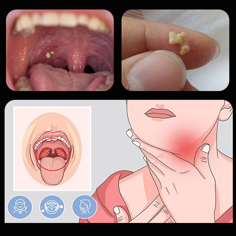 ~Ear Wax Tonsil Stone Remover  - Ear Wax Remover 评论和价格